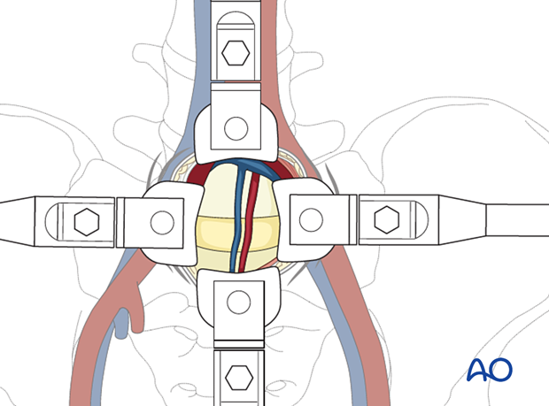 57b A720 Retroperitoneal approach for ALIF