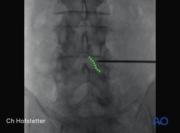 Using AP intraoperative imaging to identify the inferior medial edge of the cranial level on the ipsilateral side during minimally invasive surgery on the lumbar spine.