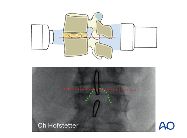 Positioning the C-arm during minimally invasive surgery on the lumbar spine.