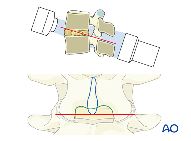 57b P520 Lumbar endoscopic unilateral laminotomy for bilateral decompression LE-ULBD