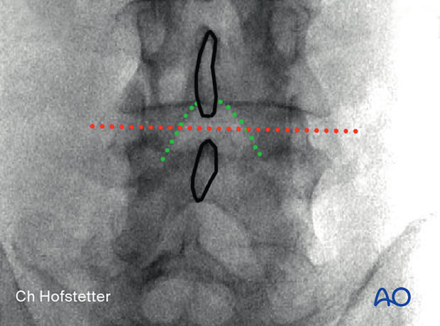 Optimizing the approach corridor to the lateral recess during minimally invasive surgery on the lumbar spine.