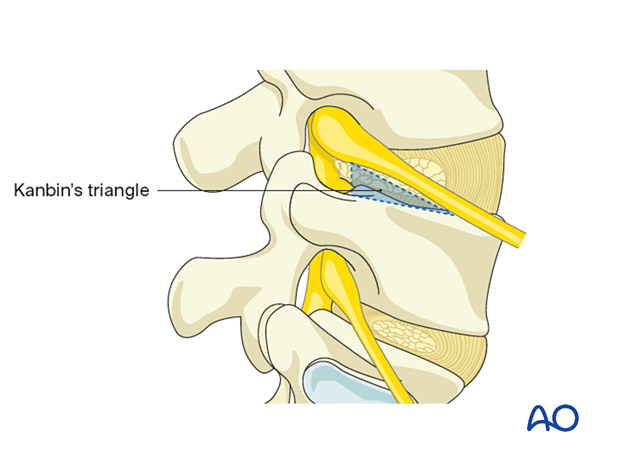 57b P410 Transforaminal endoscopic lumbar discectomy TELD