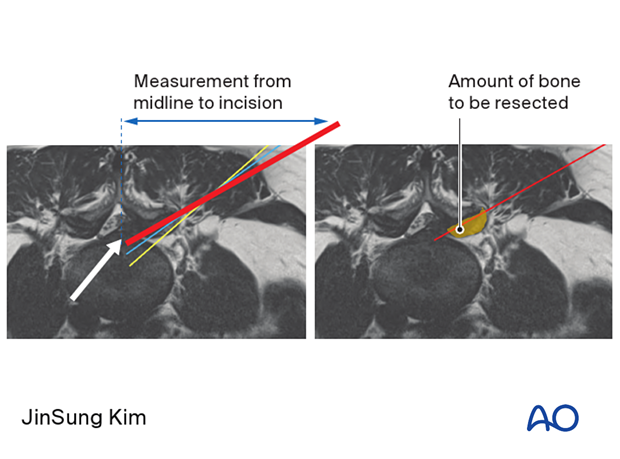 Preoperative trajectory planning during Transforaminal endoscopic lumbar discectomy (TELD)