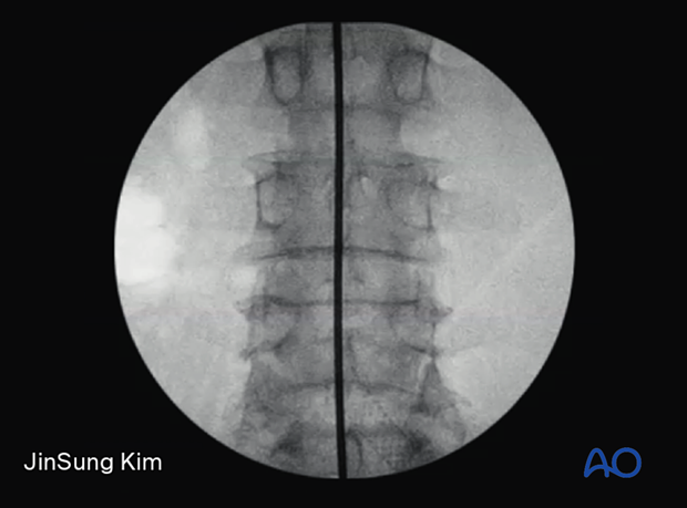 57b P320 Extraforaminal endoscopic lumbar discectomy EELD