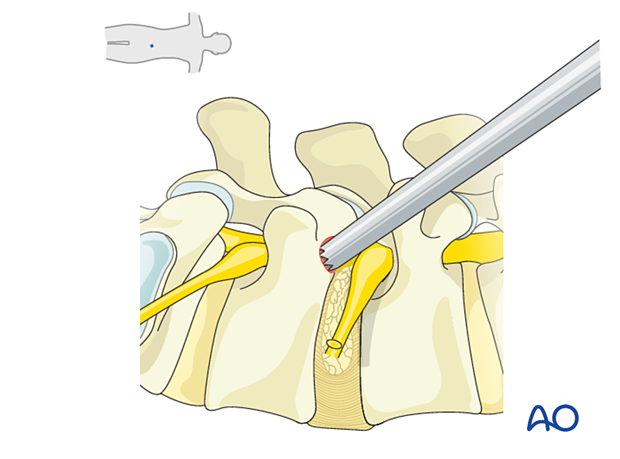 Using reamers of increasing size to perform a foraminoplasty during Transforaminal endoscopic lumbar discectomy (TELD)