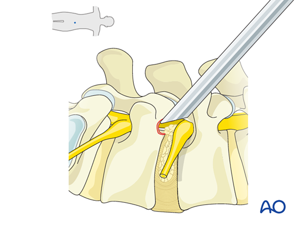 Inserting the beveled working channel during Transforaminal endoscopic lumbar discectomy (TELD)