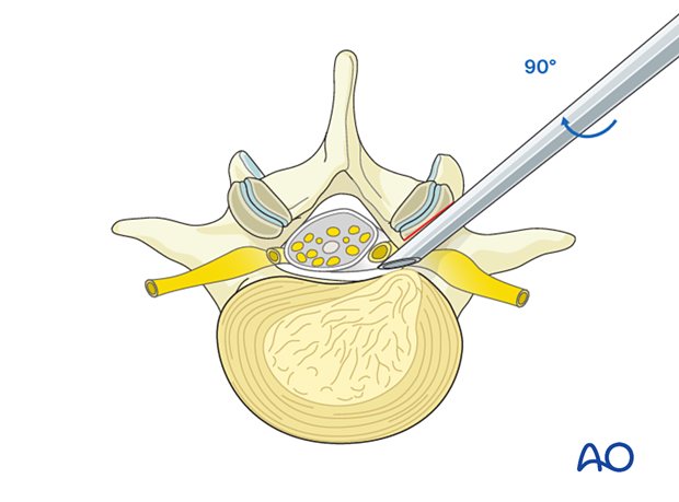 57b P410 Transforaminal endoscopic lumbar discectomy TELD