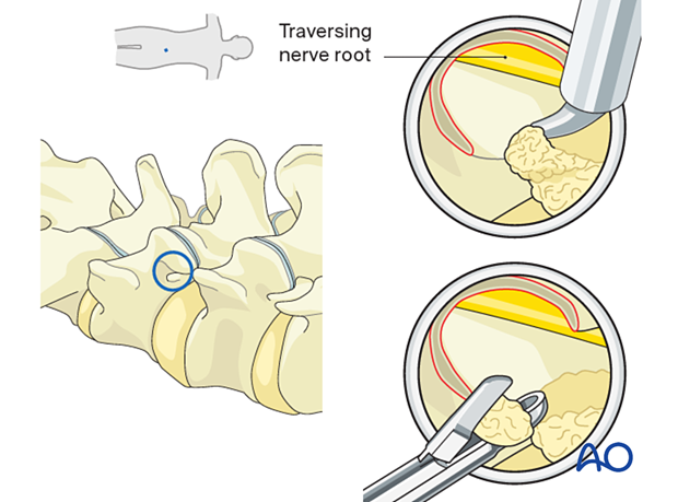 57b P410 Transforaminal endoscopic lumbar discectomy TELD