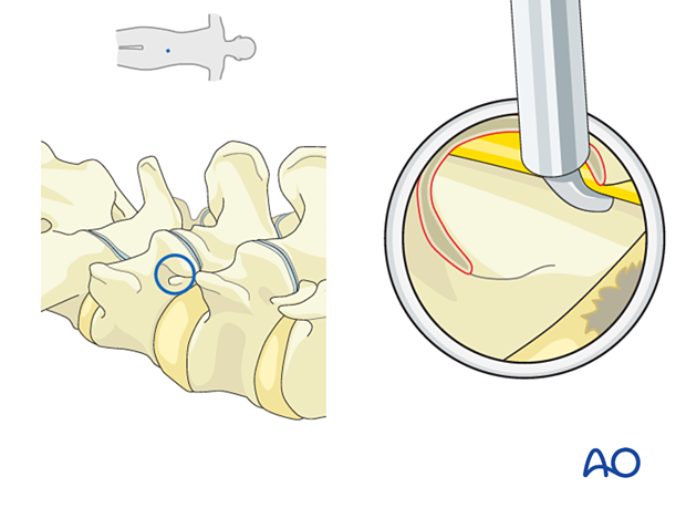 57b P410 Transforaminal endoscopic lumbar discectomy TELD