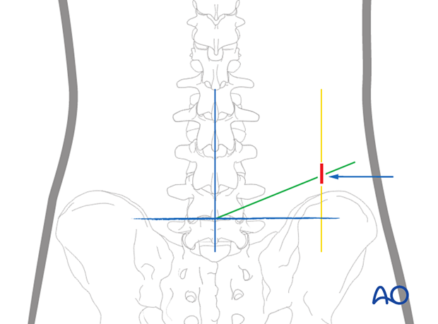 Making the incision during Transforaminal endoscopic lumbar discectomy (TELD)