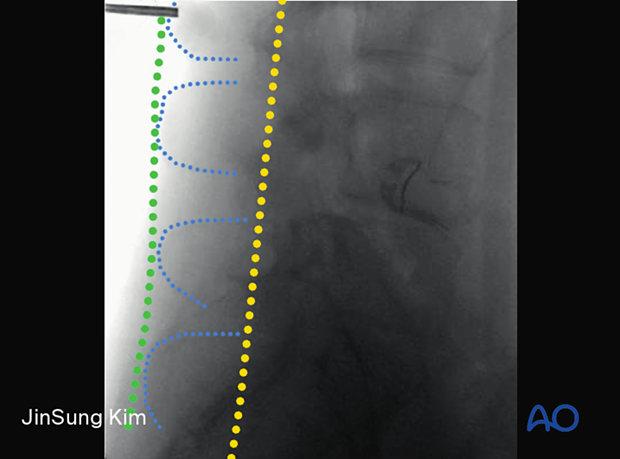 57b P320 Extraforaminal endoscopic lumbar discectomy EELD