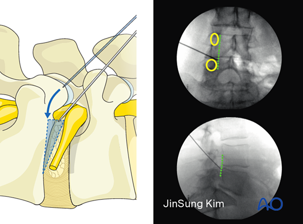 Insert the spinal needle at the entry site during Transforaminal endoscopic lumbar discectomy (TELD)