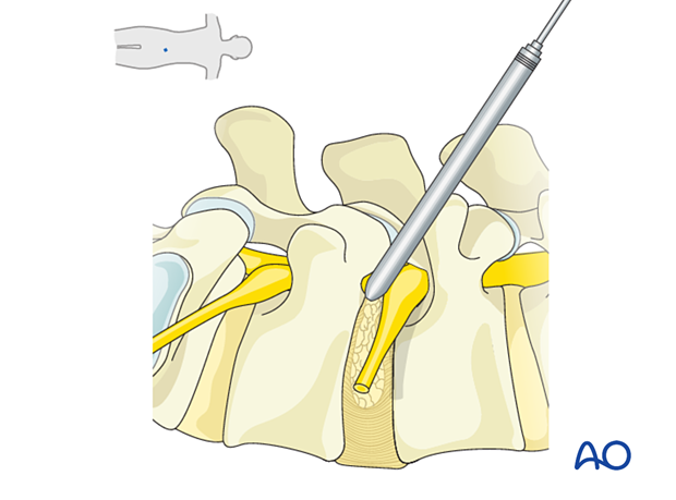 Use serial dilators to expand the working corridor during Transforaminal endoscopic lumbar discectomy (TELD)