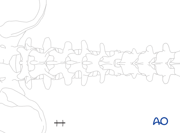 Closure during an endoscopic lumbar discectomy.