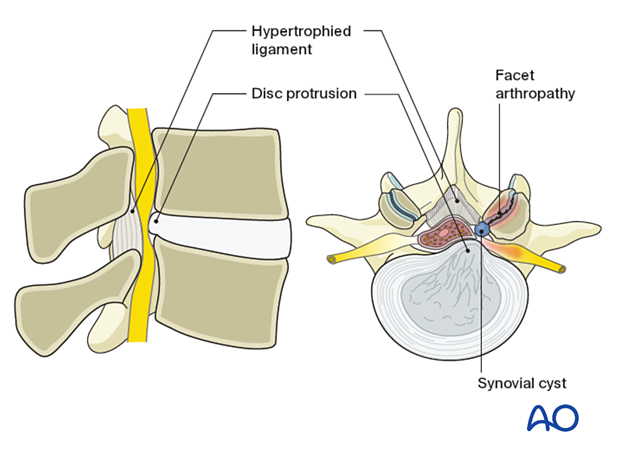 57b P510 Microscopic tubular unilateral laminotomy for bilateral decompression MT-ULBD