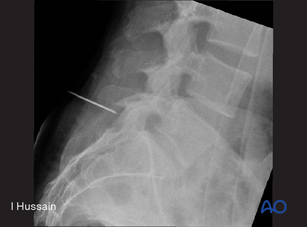 57b P510 Microscopic tubular unilateral laminotomy for bilateral decompression MT-ULBD