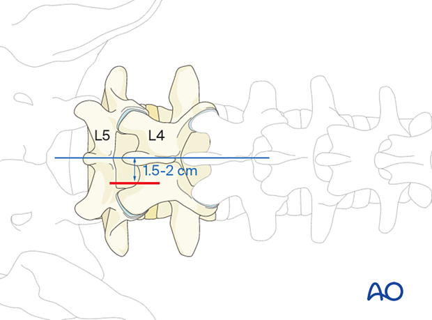 57b P210 Interlaminar microscopic tubular lumbar discectomy IMTLD