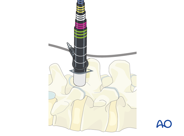 Insertion of sequential dilators during Microscopic tubular unilateral laminotomy for bilateral decompression (MT-ULBD)