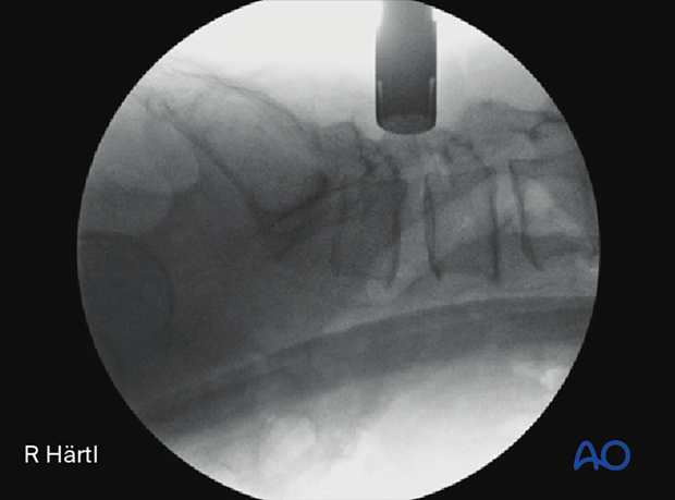 57b P600 MISS Transforaminal lumbar interbody fusion TLIF