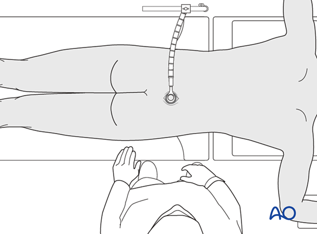 Securing the retractor to the table-mounted arm during minimally invasive surgery on the lumbar spine.