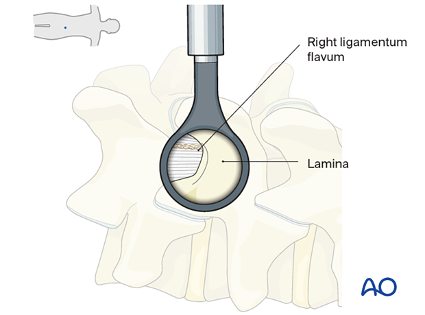 57b P510 Microscopic tubular unilateral laminotomy for bilateral decompression MT-ULBD