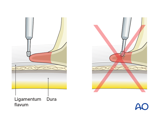 Using a burr to provide adequate exposure to the traversing nerve root during minimally invasive surgery on the lumbar spine.