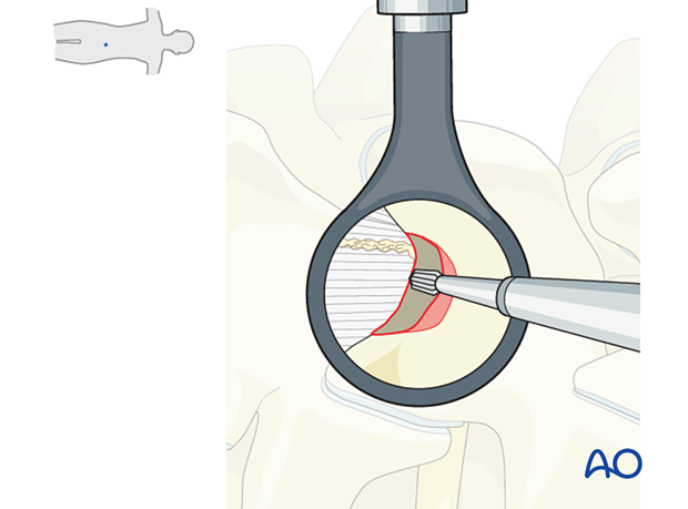 57b P510 Microscopic tubular unilateral laminotomy for bilateral decompression MT-ULBD