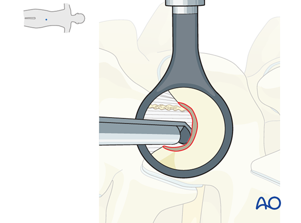 Removing the last millimeters of the lamina using Kerrison rongeurs during Microscopic tubular unilateral laminotomy for bilateral decompression (MT-ULBD)