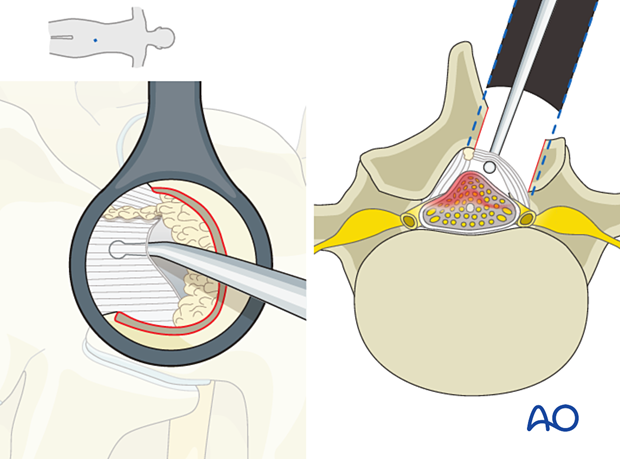 57b P510 Microscopic tubular unilateral laminotomy for bilateral decompression MT-ULBD