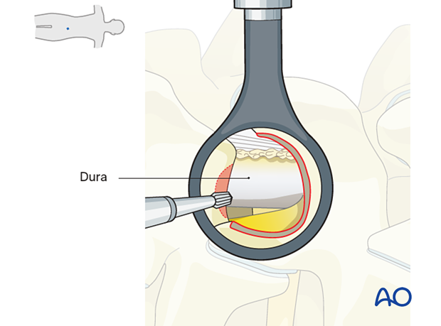 57b P510 Microscopic tubular unilateral laminotomy for bilateral decompression MT-ULBD