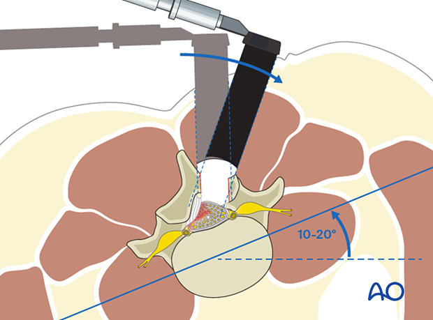 57b P510 Microscopic tubular unilateral laminotomy for bilateral decompression MT-ULBD