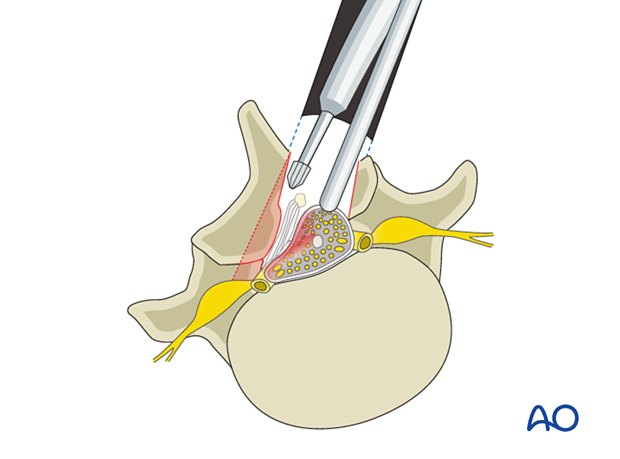 57b P510 Microscopic tubular unilateral laminotomy for bilateral decompression MT-ULBD