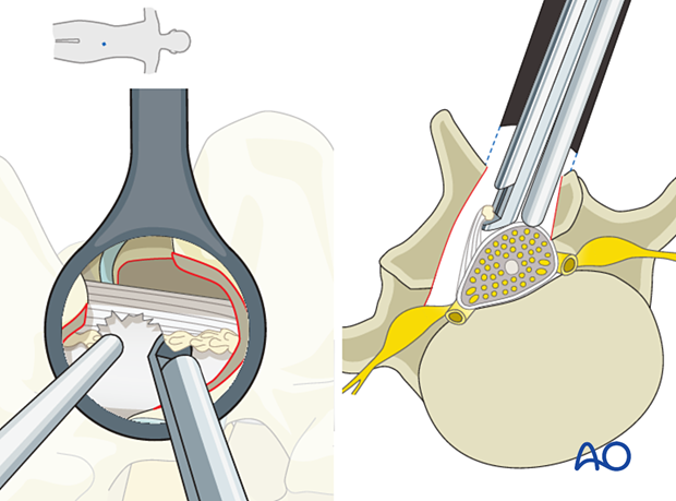 57b P510 Microscopic tubular unilateral laminotomy for bilateral decompression MT-ULBD