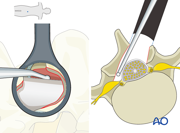 approach to the le fort i level of the midface in cleft lip and palate patients