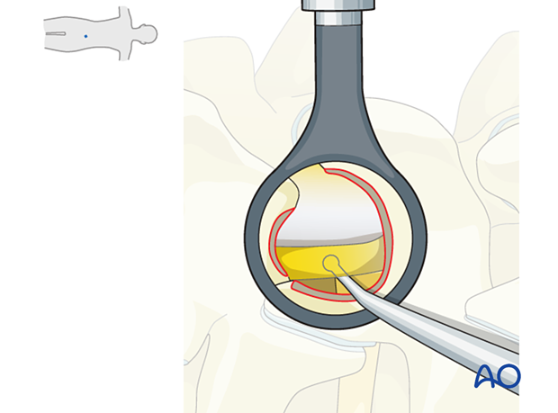 Ensuring adequate decompression of the ipsilateral traversing nerve root during Microscopic tubular unilateral laminotomy for bilateral decompression (MT-ULBD)