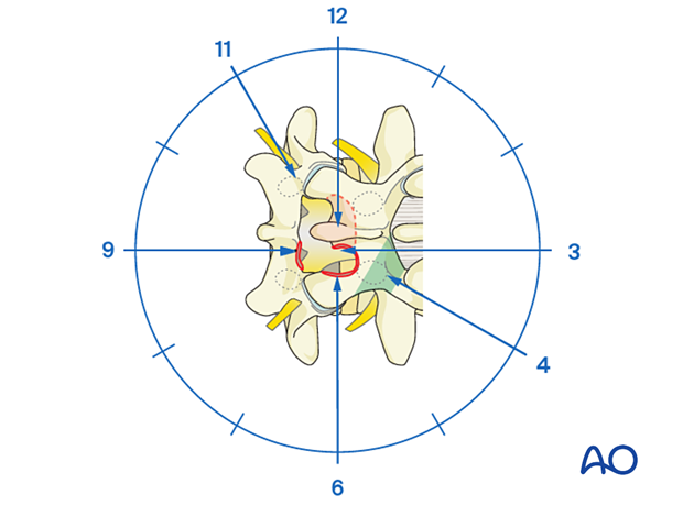 Verifying decompression during Microscopic tubular unilateral laminotomy for bilateral decompression (MT-ULBD)