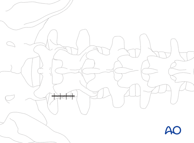 Closure of wound during Microscopic tubular unilateral laminotomy for bilateral decompression (MT-ULBD)