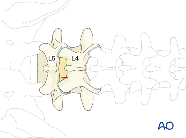 Making the incision during minimally invasive surgery on the lumbar spine.