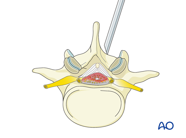 57b P520 Lumbar endoscopic unilateral laminotomy for bilateral decompression LE-ULBD