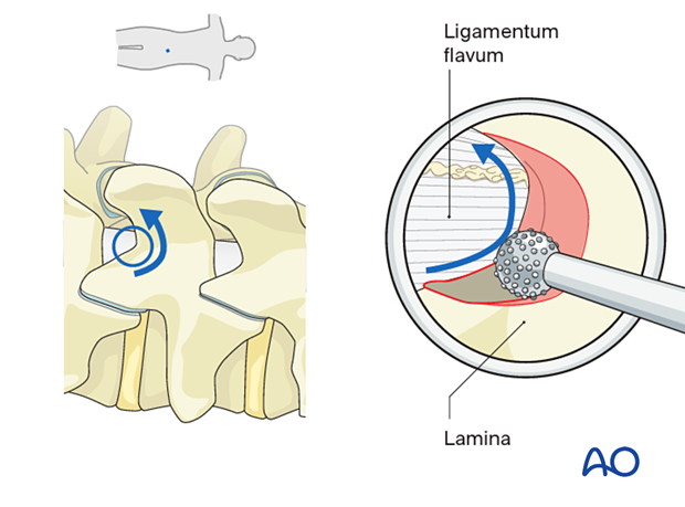 Drilling the inferior edge of the cranial lamina during Lumbar endoscopic unilateral laminotomy for bilateral decompression (LE-ULBD).