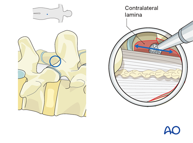 Undercutting the contralateral lamina during Lumbar endoscopic unilateral laminotomy for bilateral decompression (LE-ULBD).