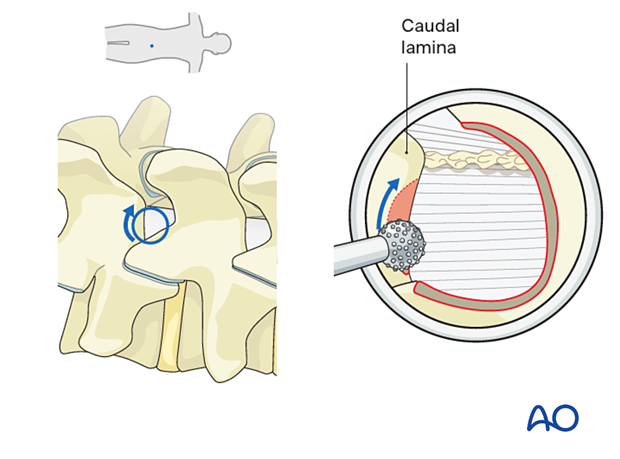 The contralateral superior edge of the caudal lamina is drilled down to the ligamentum flavum during Lumbar endoscopic unilateral laminotomy for bilateral decompression (LE-ULBD).