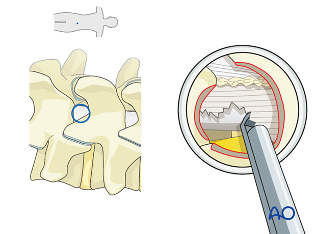 Detaching the ligamentum flavum during Lumbar endoscopic unilateral laminotomy for bilateral decompression (LE-ULBD).