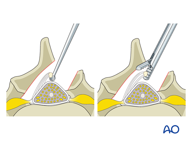 Resecting the ligament during Lumbar endoscopic unilateral laminotomy for bilateral decompression (LE-ULBD).