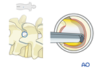 Lumbar endoscopic unilateral laminotomy for bilateral decompression (LE-ULBD)