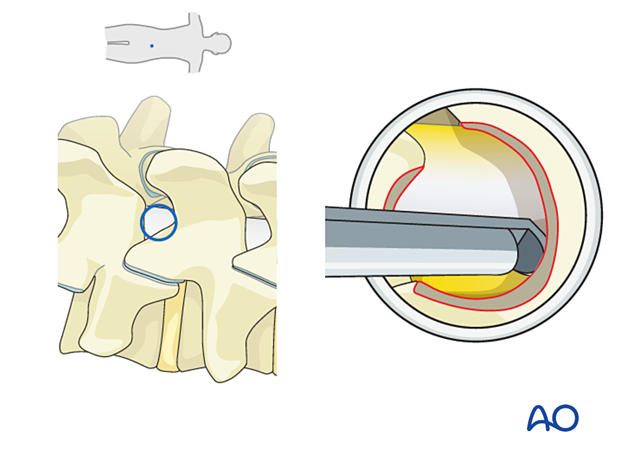 Lateral recess decompression during Lumbar endoscopic unilateral laminotomy for bilateral decompression (LE-ULBD)