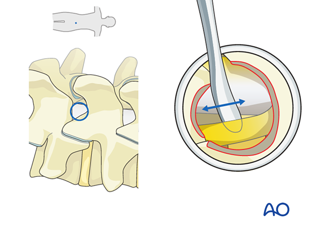 57b P520 Lumbar endoscopic unilateral laminotomy for bilateral decompression LE-ULBD