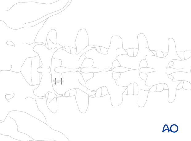 Closure of the wound during Lumbar endoscopic unilateral laminotomy for bilateral decompression (LE-ULBD).