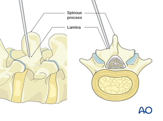 Inserting the first dilator during MISS Transforaminal lumbar interbody fusion (TLIF)