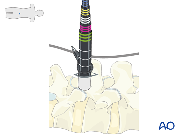 Insertion of sequential dilators during MISS Transforaminal lumbar interbody fusion (TLIF)